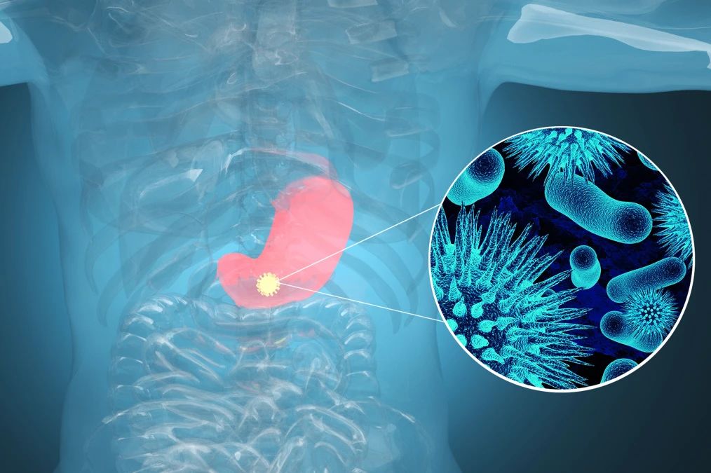 肿瘤标记物CA72-4：“胃”，，，，，，，你还好吗？？？？？？